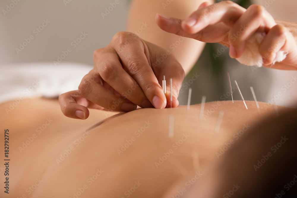 The doctor sticks needles into the girl's body on the acupuncture - close up - obrazy, fototapety, plakaty 