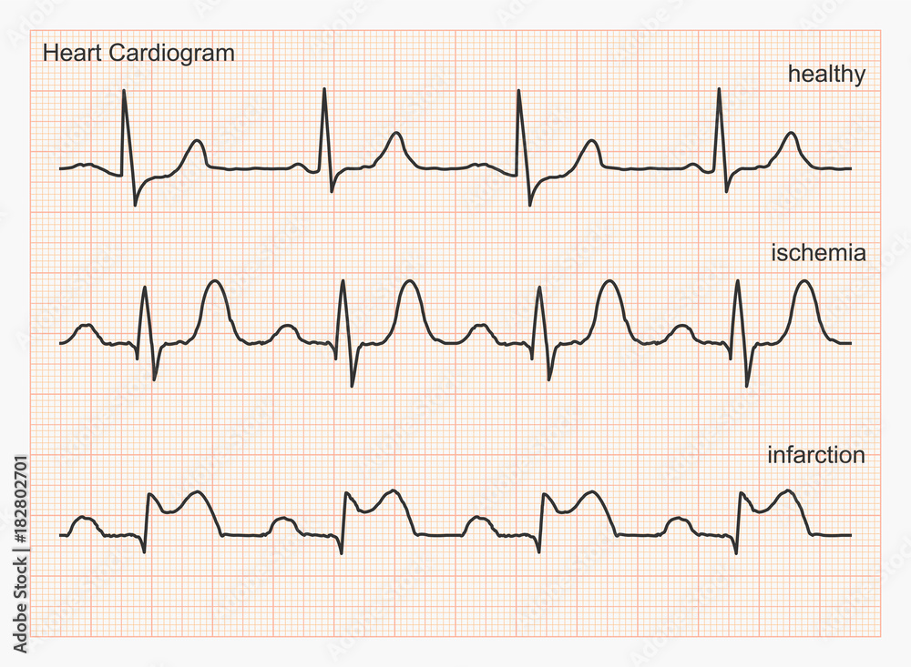 Three types of cardiograms: healthy heart rhythm, ischemia, infarction ...