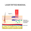 © designua - Laser tattoo removal.