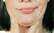 © Angelina - face line correction. a woman with a second chin