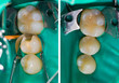 © Sandor Kacso - Dental filling comparison, before - after