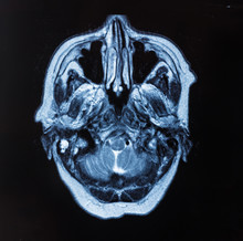 Head MRT. MR Image Of Human Brain
