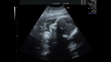 Ultrasound Of A Pregnant Woman With A Baby