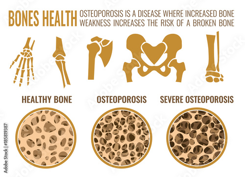 Cuadros en Lienzo Osteoporosis Stages Image