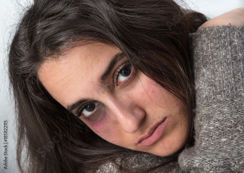 Attractive woman with a bruised black eye Poster