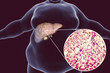 © Dr_Microbe - Obese man with fatty liver, 3D illustration and photomicrograph of liver steatosis. Conceptual image for non-alcoholic fatty liver disease
