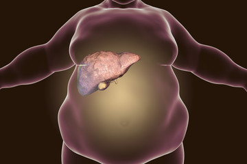 Poster - Obese man with fatty liver, 3D illustration. Conceptual image for non-alcoholic fatty liver disease