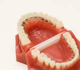 Fototapeta Na ścianę - Dentist demonstration teeth model of orthodontic bracket