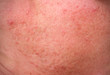 rosacea skin disease on the face