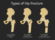 © Double Brain - Types of hip fracture