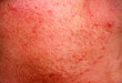 rosacea skin disease on the face