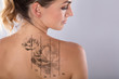 © Andrey Popov - Laser Tattoo Removal On Woman's Shoulder