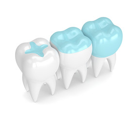 Wall Mural - 3d render of teeth with different types of filling