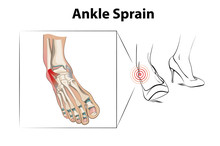 Ankle Sprain Is A Injury From Wearing High Heels