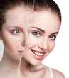 Compare of old photo with acne and new healthy skin.