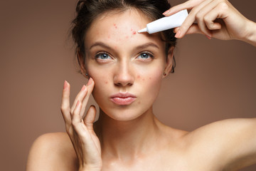 teen girl with problem skin applying treatment cream on beige background. skin care concept