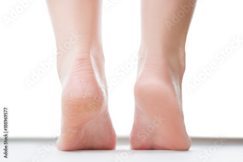 Fotomural Before after feet care concept, female foot