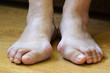 © GarkushaArt - Problem feet with bunion (Hallux valgus)