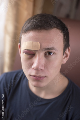 Fotografie, Obraz A young man with a bruise in his eye and a band-aid posing for the camera