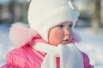 beautiful baby girl with frostbitten face or with allergic rash on cheeks playing in the snow outdoors in winter