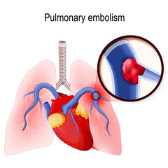 Wall Mural - Pulmonary embolism