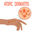Atopic dermatitis health,  medical,  skin,  pain,  dermatitis,  eczema,