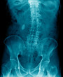 x-ray image show scoliosis thoracic spine