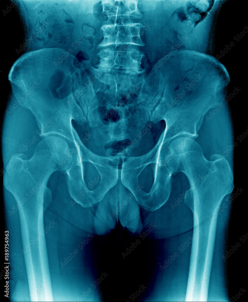 x-ray image pelvic bone and part of femur, spine Stock Photo | Adobe Stock