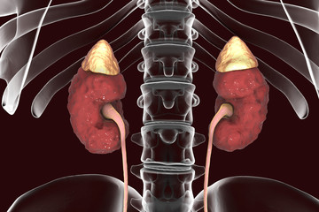 Poster - Chronic kidney disease, 3D illustration showing diseased kidney with adrenal glands, urethers and skeleton