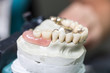 Zahnprothese auf Prothesensattel im Zahnlabor