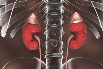 Sticker - Chronic kidney disease, 3D illustration showing diseased kidney with adrenal glands, urethers and skeleton