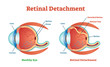 Retinal Detachment vector illustration diagram, anatomical scheme. 