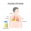 Pleural effusion. Treatment of tension hydrothorax