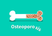 Osteoporosis, Bone Structure In Vector Design