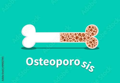 Cuadros en Lienzo Osteoporosis, Bone structure in vector design