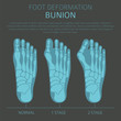 © a7880ss - Foot deformation as medical desease infographic. Causes of bunion