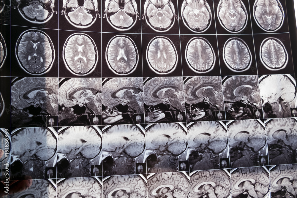 Photo Stock Closeup of a CT scan and skull on it. health medical image ...