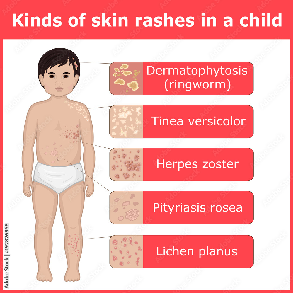 Skin Rash In Kids Kinds of skin rashes in a child 素材庫向量圖 | Adobe Stock