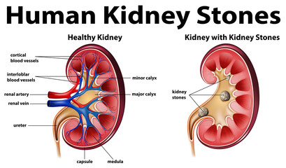 Canvas Print - Human anatomy diagram with kidney stones