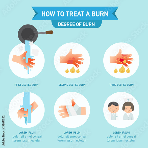 How to treat a burn infographic,vector illustration Vecteur Stock Adobe Stock