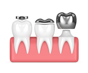 Wall Mural - 3d render of teeth with different types of dental amalgam filling