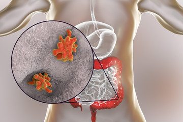 Wall Mural - Entamoeba histolytica protozoan infection of large intestine. Parasite which causes amoebic dysentery and ulcers. 3D illustration