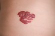 Infantile Hemangioma red birthmark (also called strawberry mark) on the baby's belly. Infantile Hemangiomas (IHs) are the most common tumors of childhood.