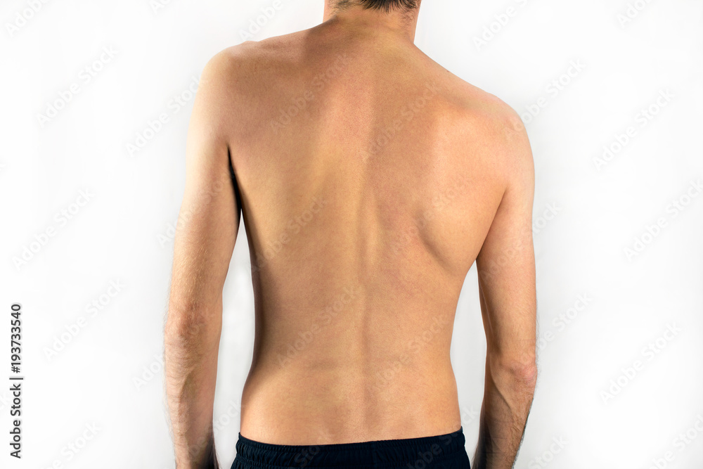 scoliosis of the back of a man selective focus, white background Stock ...