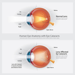 Cataracts Vision Disorder and Normal Eye Vision Anatomy Vector illustration