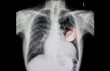 Chest x-ray film of a patient with cardiac pacemaker.