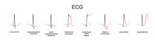 Interpretation Of ECG