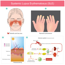 Systemic Lupus Erythematosus (SLE). The Patients Skin Inflammation From The Light. Illustration.