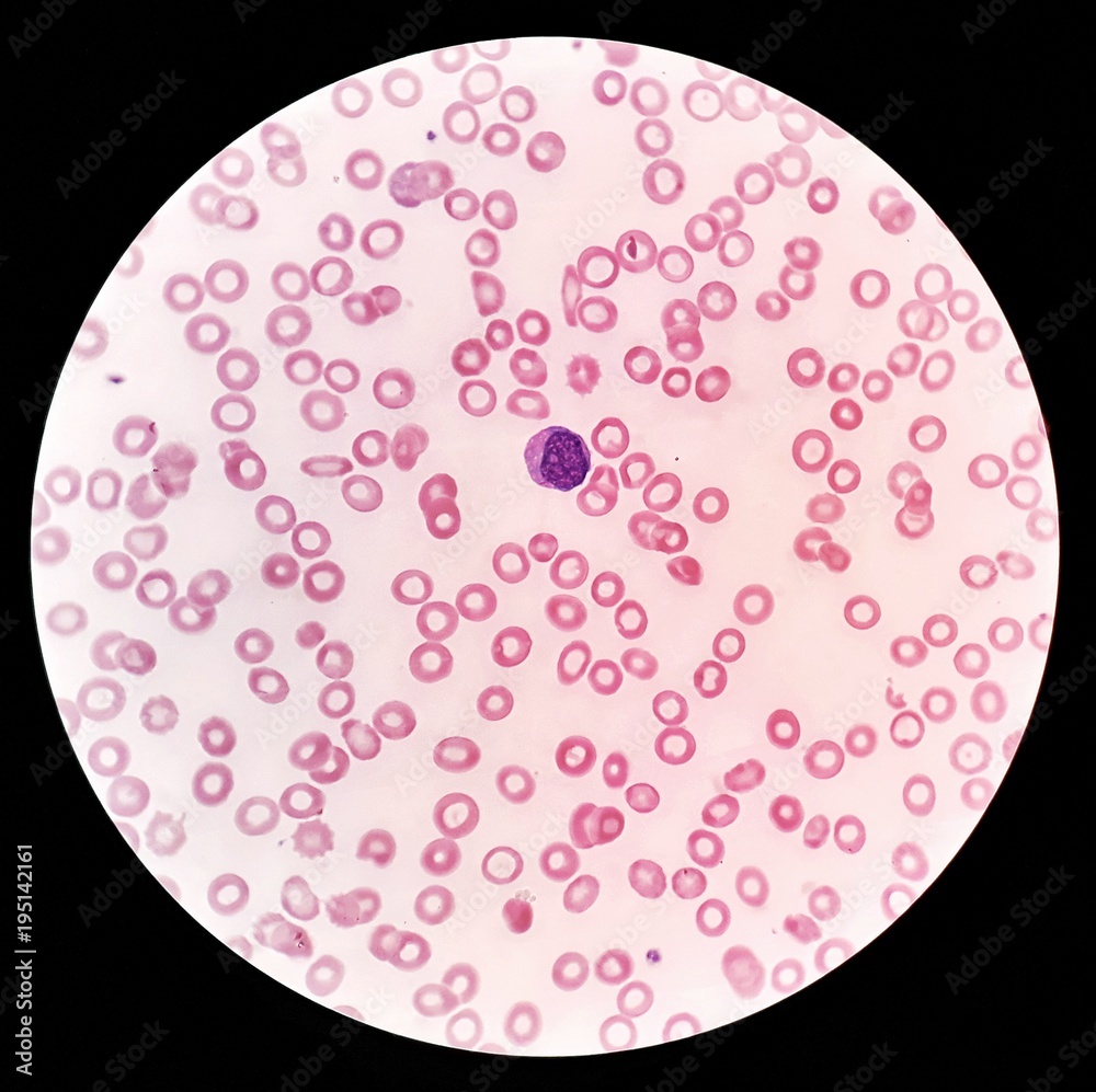 Human blood smear under 100X light microscope with a blast cell and ...