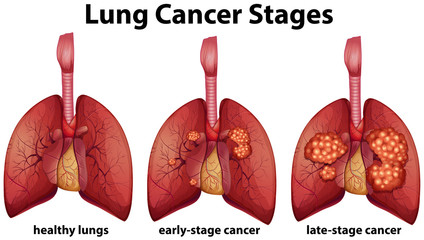 Wall Mural - Diagram showing lung cancer stages
